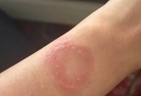 ساعة آبل تسبب حروقًا