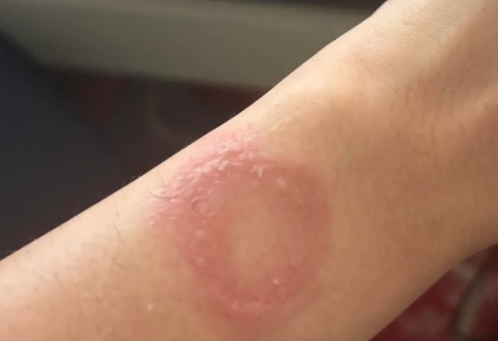 ساعة آبل تسبب حروقًا